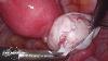 Laparoscopic Resection Of A Four And Half Centimetre Dermoid Cyst
